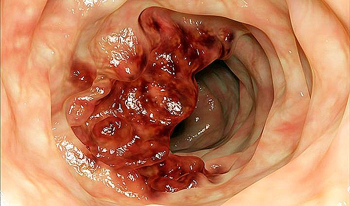 Cáncer de colon y recto - Síntomas, Causas y Tratamiento