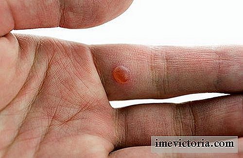 10 Home Remedies for Warts