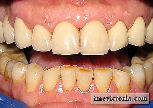 10 Maneras de eliminar naturalmente la placa dental
