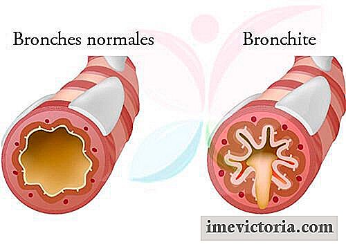 5 Curas eficaces para el tratamiento de la bronquitis