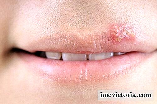 5 Remedios caseros para tratar el herpes labial