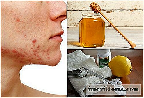 6 Remedios naturales para el acné quístico