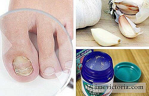 7 Domácí opravné prostředky k boji proti houbovým infekcí nehtů na nohou a rukou