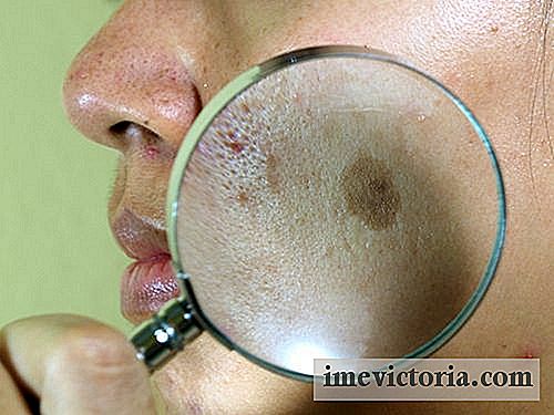 7 Přírodní léčby proti skvrnám na tváři