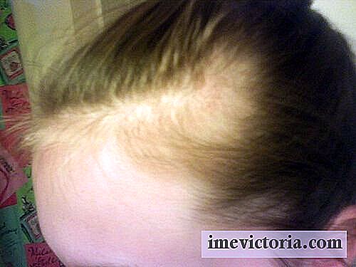 Basil remedy for alopecia