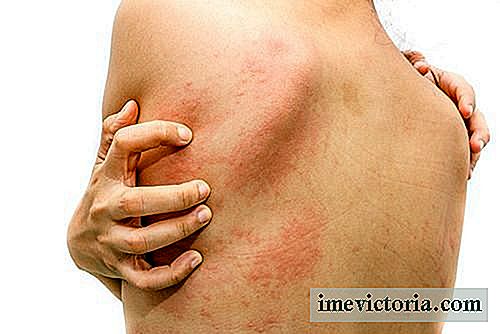 Home Remedies for Urticaria