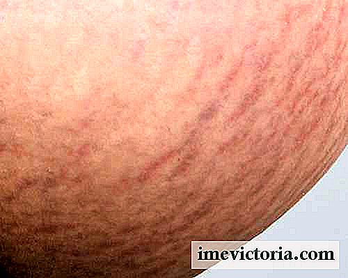 Home Remedies for at reducere stretch marks