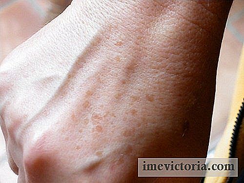 Hvordan laver hjemmelavet cremer til behandling af pletter på hænder