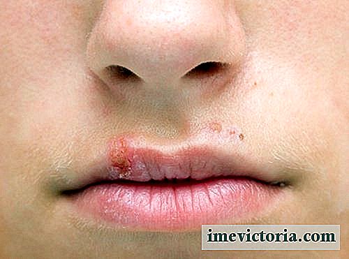 Cómo detener de forma natural el herpes labial en una noche