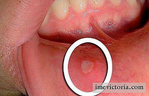 Sådan behandler sår i munden og sår i munden?