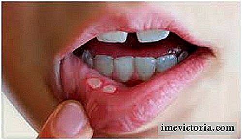 Cómo tratar las úlceras bucales y úlceras en la boca de forma natural