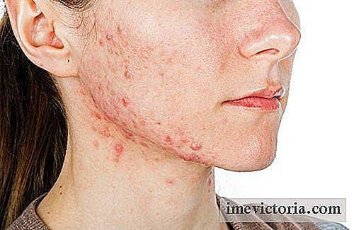 Interne behandlinger til bekæmpelse af acne