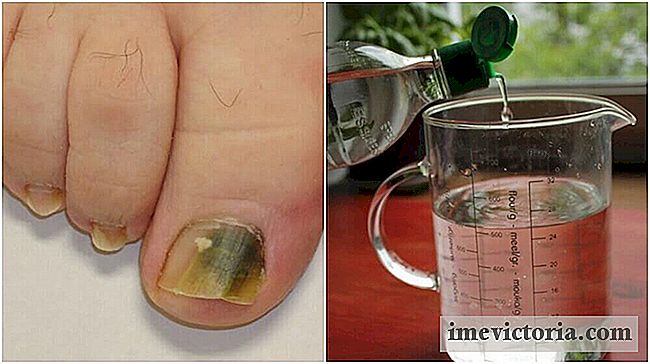 De alcohol a base de recetas e ingredientes naturales para combatir hongos en las uñas