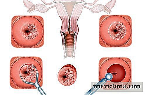 Síntomas y tratamiento de la erosión cervical