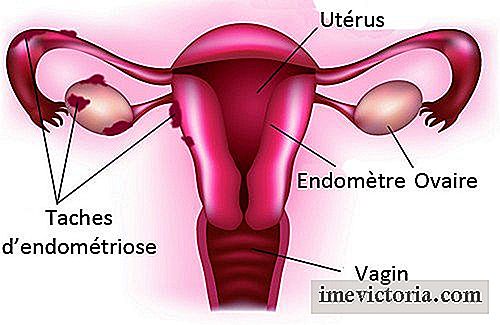 De vigtigste symptomer på endometriose
