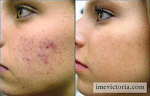 4 Hjemmelavede anti-acne masker